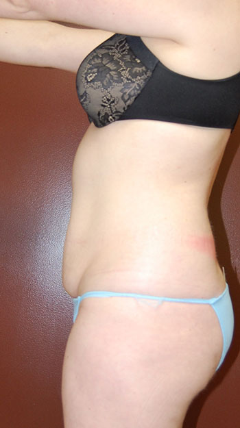 Abdominoplasty