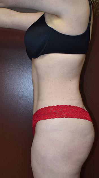 Abdominoplasty