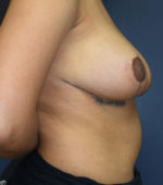 Breast Reduction