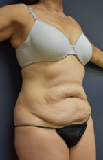 Abdominoplasty