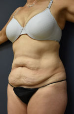 Abdominoplasty