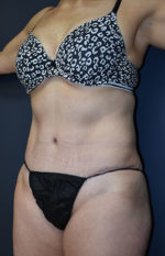 Abdominoplasty