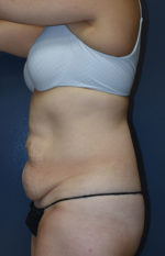 Abdominoplasty