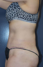 Abdominoplasty