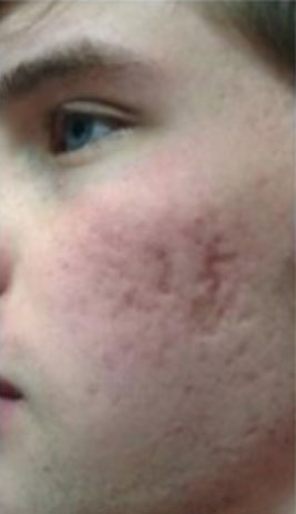 Microneedling with the Rejuvapen