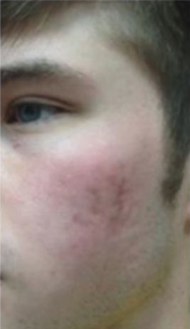 Microneedling with the Rejuvapen