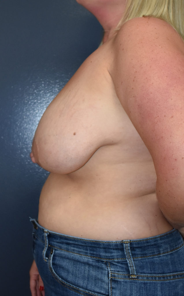 Breast Reduction