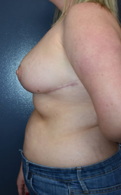 Breast Reduction