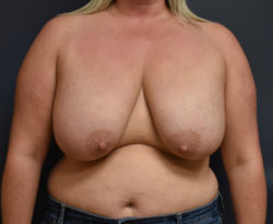 Breast Reduction