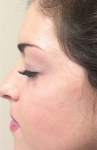 Microneedling with the Rejuvapen