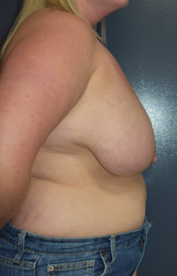 Breast Reduction