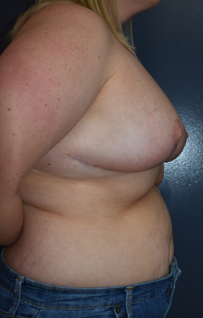 Breast Reduction