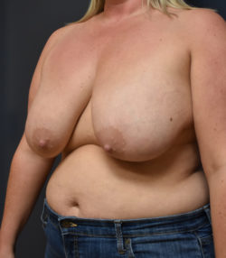 Breast Reduction