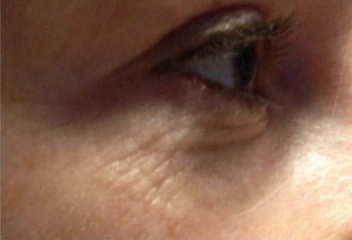 Microneedling with the Rejuvapen
