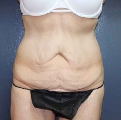 Abdominoplasty