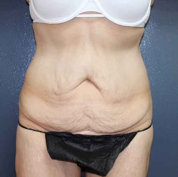 Abdominoplasty Case 23706 Before Photo Abdominoplasty