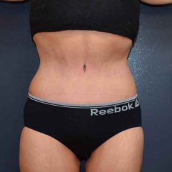 Abdominoplasty