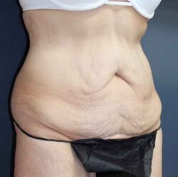 Abdominoplasty