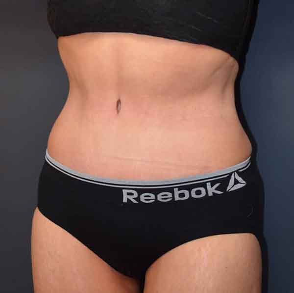 Abdominoplasty