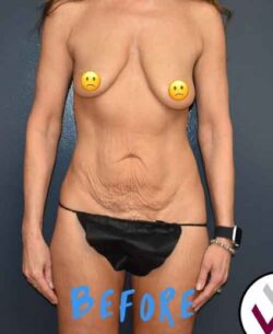 Abdominoplasty