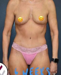 Abdominoplasty