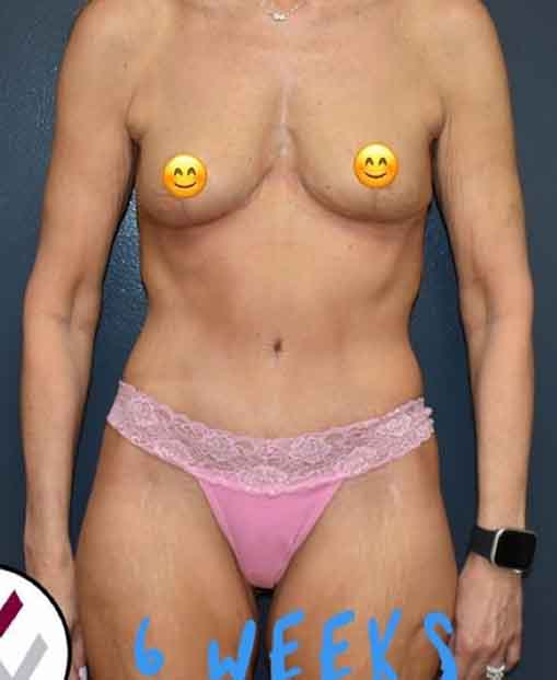 Abdominoplasty Case 23723 After Photo Abdominoplasty