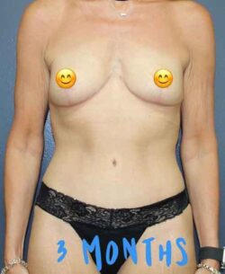 Abdominoplasty