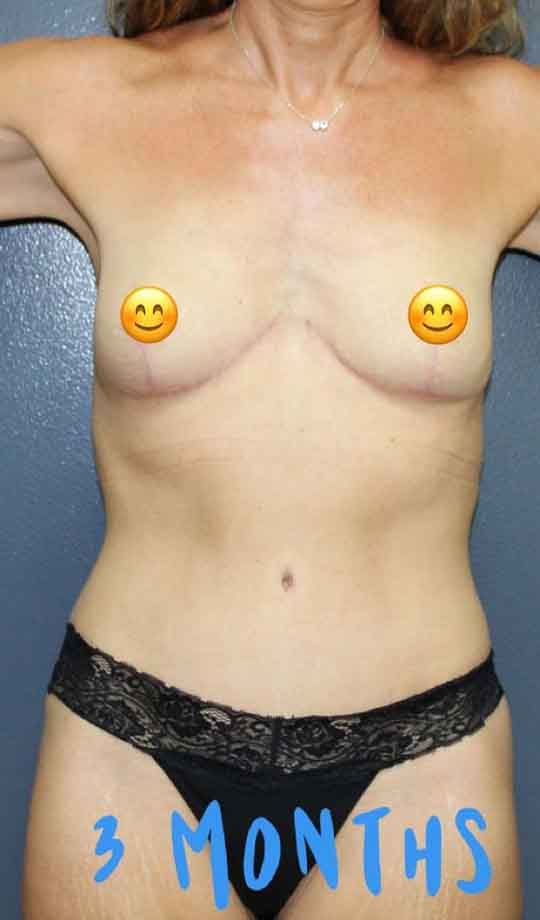 Abdominoplasty