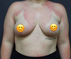 Breast Reduction