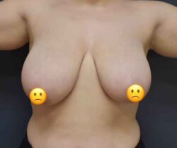 Breast Reduction