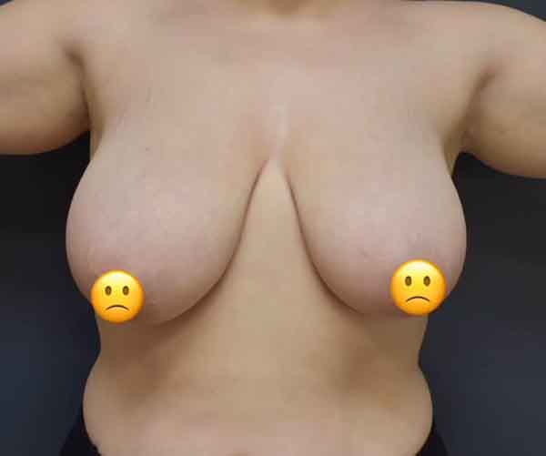 Breast Reduction