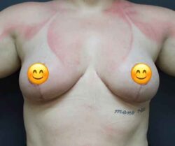 Breast Reduction