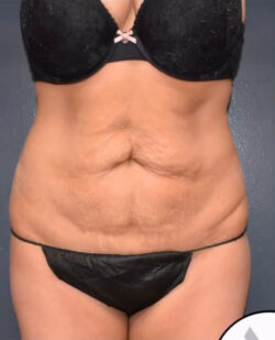 Abdominoplasty