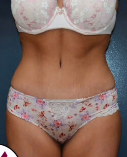 Abdominoplasty