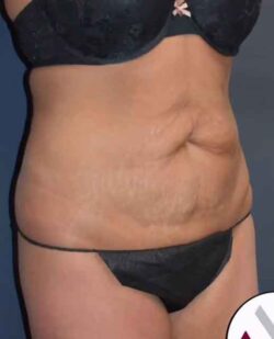Abdominoplasty