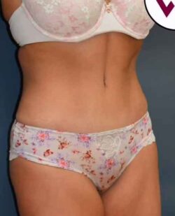 Abdominoplasty