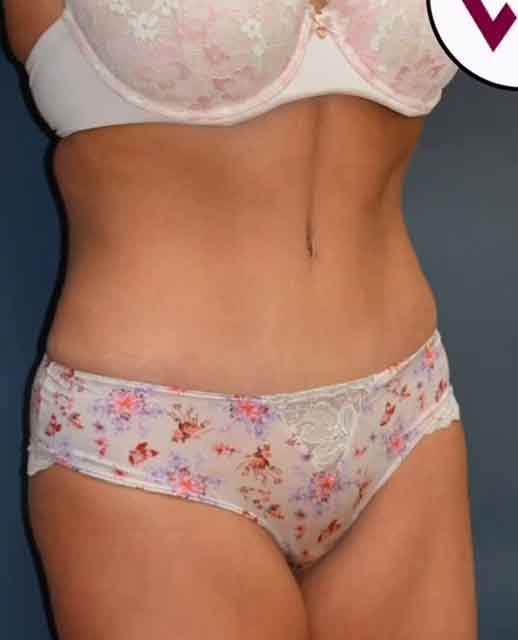 Abdominoplasty