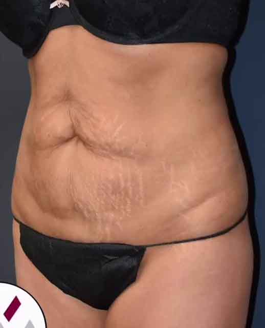 Abdominoplasty