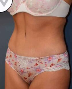 Abdominoplasty