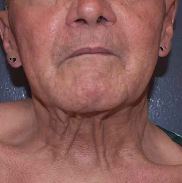 Neck Lift
