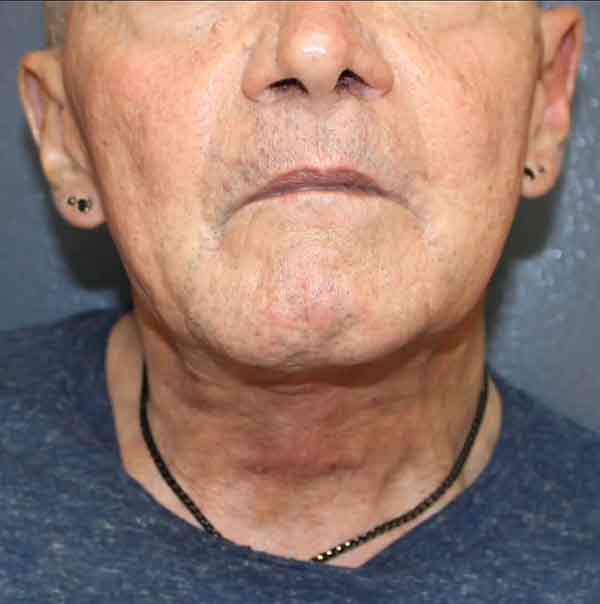 Neck Lift