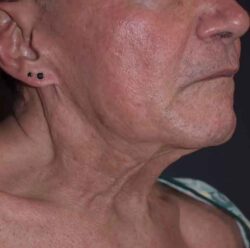 Neck Lift