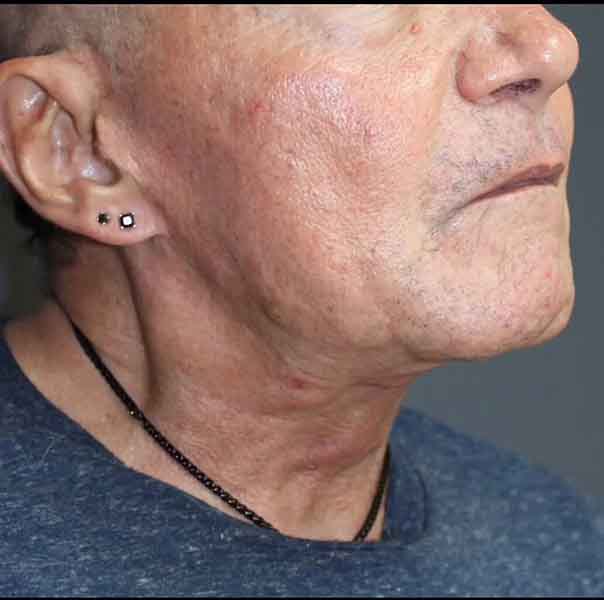 Neck Lift