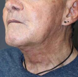 Neck Lift