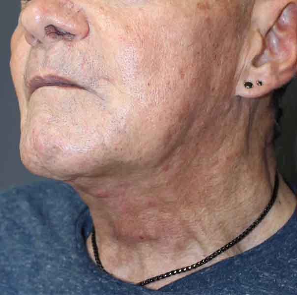 Neck Lift