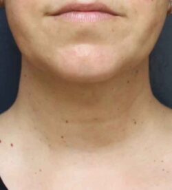 Neck Liposuction