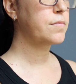 Neck Liposuction