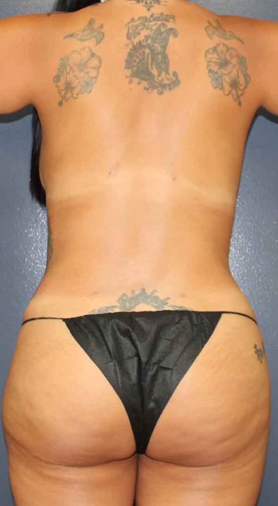 Liposuction Case 23734 After Photo Liposuction