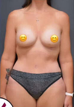 Mommy Makeover