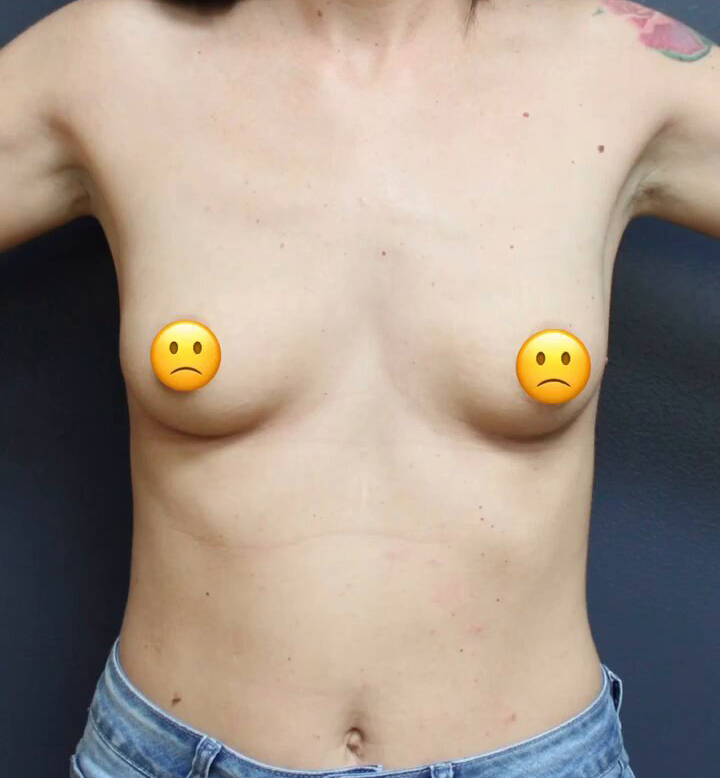 Breast Augmentation